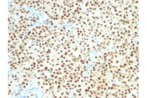 Formalin-fixed, paraffin-embedded human Melanoma stained with SOX10 Mouse Monoclonal Antibody (SOX10/1074). (SOX10 anticorps  (AA 115-269))