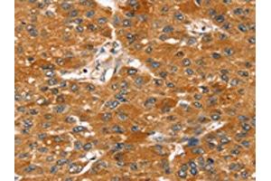 The image on the left is immunohistochemistry of paraffin-embedded Human liver cancer tissue using ABIN7131212(STARD8 Antibody) at dilution 1/20, on the right is treated with fusion protein. (STARD8 anticorps)
