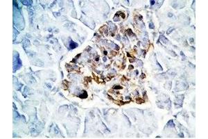 Human pancreas cancer tissue was stained by Rabbit Anti-GLP-1(7-36) -NH2 Antibody (GLP-1 anticorps  (amidated))