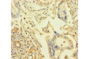 Immunohistochemistry of paraffin-embedded human pancreatic cancer using ABIN7167948 at dilution of 1:100 (ARHGAP27 anticorps  (AA 1-300))