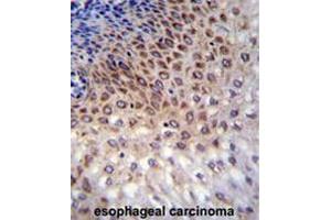CCDC36 Antibody (C-term) immunohistochemistry analysis in formalin fixed and paraffin embedded human esophageal carcinoma followed by peroxidase conjugation of the secondary antibody and DAB staining. (CCDC36 anticorps  (C-Term))