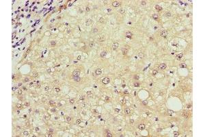 Immunohistochemistry of paraffin-embedded human liver cancer using ABIN7168042 at dilution of 1:100 (RHOJ anticorps  (AA 1-211))
