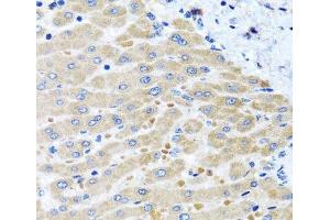 Immunohistochemistry of paraffin-embedded Human liver damage using DARS2 Polyclonal Antibody at dilution of 1:100 (40x lens). (DARS2 anticorps)