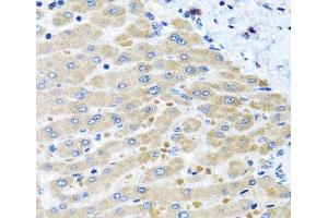 Immunohistochemistry of paraffin-embedded Human liver damage using DARS2 Polyclonal Antibody at dilution of 1:100 (40x lens).