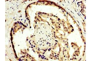IHC image of ABIN7163426 diluted at 1:300 and staining in paraffin-embedded human prostate cancer performed on a Leica BondTM system. (NR2E3 anticorps  (AA 112-222))
