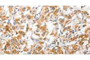 Immunohistochemistry of paraffin-embedded Human thyroid cancer tissue using ANAPC2 Polyclonal Antibody at dilution 1:30 (ANAPC2 anticorps)