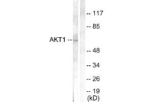 Immunohistochemistry analysis of paraffin-embedded human breast carcinoma tissue using Akt (Ab-308) antibody. (AKT1 anticorps  (Thr308))