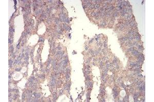 Immunohistochemical analysis of paraffin-embedded rectum cancer tissues using WNT3A mouse mAb with DAB staining. (WNT3A anticorps  (AA 170-352))