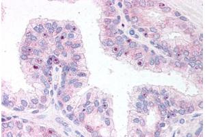 Human Prostate (formalin-fixed, paraffin-embedded) stained with ERG antibody ABIN295774 at 10 ug/ml followed by biotinylated anti-goat IgG secondary antibody ABIN481715, alkaline phosphatase-streptavidin and chromogen. (ERG anticorps  (AA 469-481))