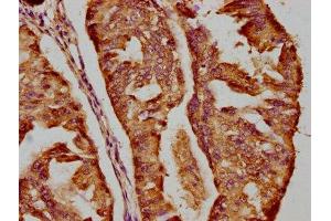 IHC image of ABIN7151707 diluted at 1:200 and staining in paraffin-embedded human endometrial cancer performed on a Leica BondTM system.