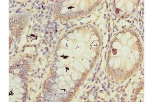 Immunohistochemistry of paraffin-embedded human colon cancer using ABIN7152486 at dilution of 1:100