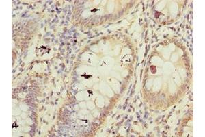 Immunohistochemistry of paraffin-embedded human colon cancer using ABIN7152486 at dilution of 1:100 (BTRC anticorps  (AA 701-1000))