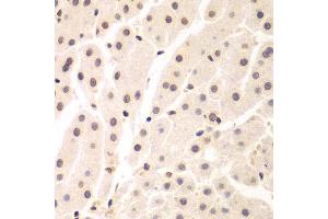 Immunohistochemistry of paraffin-embedded human liver cancer using UHRF2 antibody at dilution of 1:200 (400x lens). (UHRF2 anticorps)