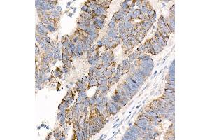 Immunohistochemistry of paraffin-embedded human colon carcinoma using  Rabbit mAb (ABIN7265424) at dilution of 1:1000 (40x lens). (ACSL4 anticorps)
