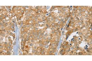 Immunohistochemistry of paraffin-embedded Human breast cancer tissue using SLC9A3R2 Polyclonal Antibody at dilution 1:30 (SLC9A3R2 anticorps)