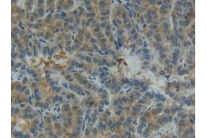Detection of MMP13 in Human Thyroid cancer Tissue using Polyclonal Antibody to Matrix Metalloproteinase 13 (MMP13)