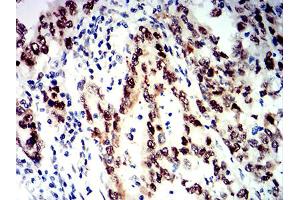 Immunohistochemical analysis of paraffin-embedded stomach cancer tissues using SMARCA1 mouse mAb with DAB staining. (SMARCA1 anticorps  (AA 933-1070))