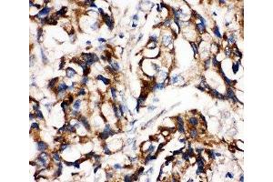 IHC-P: MEK1 antibody testing of human breast cancer tissue (MEK1 anticorps  (C-Term))
