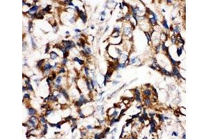 IHC-P: MEK1 antibody testing of human breast cancer tissue (MEK1 anticorps  (C-Term))