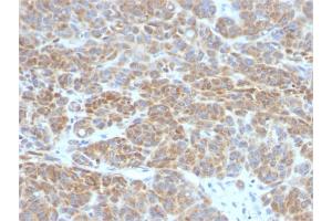 Formalin-fixed, paraffin-embedded human Melanoma stained with Bcl-2 Mouse Monoclonal Antibody (BCL2/782).
