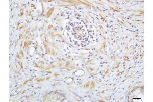 Formalin-fixed and paraffin embedded human prostate labeled with Anti-Phospho-PAK4(Ser99) Polyclonal Antibody, Unconjugated  at 1:200 followed by conjugation to the secondary antibody and DAB staining (PAK4/ 5 (pSer99) anticorps)