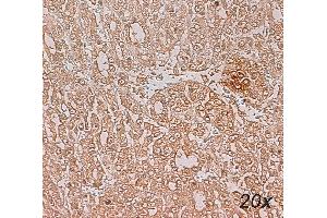 Human Liver - Hepatocarcinoma (HCC) Paraffin section, citrate, dilution 1:100 (Ephrin B2 anticorps  (Extracellular Domain))