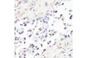 Immunohistochemistry of paraffin-embedded human lung cancer using P-MYC-T58 antibody (ABIN3019538, ABIN3019539, ABIN3019540 and ABIN6225454) at dilution of 1:100 (40x lens). (c-MYC anticorps  (pThr58))