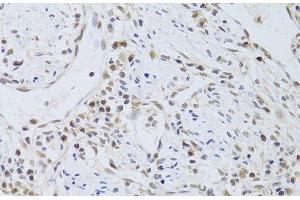 Immunohistochemistry of paraffin-embedded Human gastric cancer using FKBP4 Polyclonal Antibody at dilution of 1:100 (40x lens).