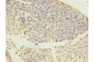 Immunohistochemistry of paraffin-embedded human cervical cancer using ABIN7144611 at dilution of 1:100 (ARMC7 anticorps  (AA 1-198))