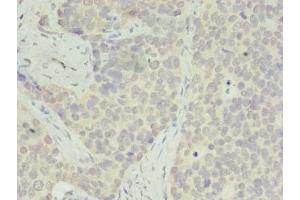 Immunohistochemistry of paraffin-embedded human gastric cancer using ABIN7142542 at dilution of 1:100 (RPS28 anticorps  (AA 1-69))