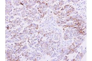 IHC-P Image NDRG1 antibody detects NDRG1 protein at membrane on human liver carcinoma by immunohistochemical analysis. (NDRG1 anticorps)