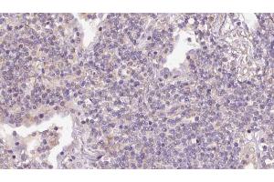 ABIN6273155 at 1/100 staining Human lymph cancer tissue by IHC-P. (RND3 anticorps  (Internal Region))