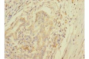 Immunohistochemistry of paraffin-embedded human pancreatic cancer using ABIN7157671 at dilution of 1:100