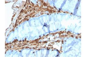 Formalin-fixed, paraffin-embedded human Colon Carcinoma stained with Annexin A1 Mouse Monoclonal Antibody (CPTC-ANXA1-1). (Annexin a1 anticorps)