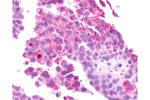 Anti-GRM2 / MGLUR2 antibody IHC of human Ovary, Carcinoma. (GRM2 anticorps  (N-Term))