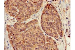 Immunohistochemistry of paraffin-embedded human ovarian cancer using ABIN7154745 at dilution of 1:100