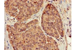 Immunohistochemistry of paraffin-embedded human ovarian cancer using ABIN7154745 at dilution of 1:100 (GNB5 anticorps  (AA 1-353))
