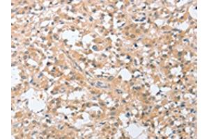 The image on the left is immunohistochemistry of paraffin-embedded Human thyroid cancer tissue using ABIN7131059(SIGLEC9 Antibody) at dilution 1/30, on the right is treated with fusion protein. (SIGLEC9 anticorps)