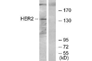Immunohistochemistry analysis of paraffin-embedded human breast carcinoma tissue using HER2 antibody. (ErbB2/Her2 anticorps)