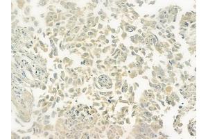 ABIN6265756 and ABIN6277746 at 1/100 staining human lung squamous cell carcinoma by IHC-P.