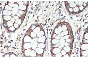 Immunohistochemistry of paraffin-embedded Human colon using APC Polyclonal Antibody at dilution of 1:200 (40x lens). (APC anticorps)