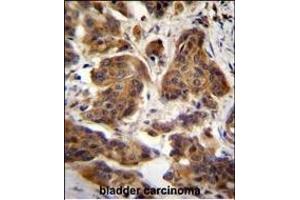 C4orf21 Antibody (N-term) (ABIN655214 and ABIN2850480) immunohistochemistry analysis in formalin fixed and paraffin embedded human bladder carcinoma followed by peroxidase conjugation of the secondary antibody and DAB staining. (ZGRF1 anticorps  (N-Term))