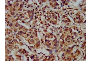 IHC image of ABIN7142850 diluted at 1:300 and staining in paraffin-embedded human liver cancer performed on a Leica BondTM system. (CYP8B1 anticorps  (AA 303-440))