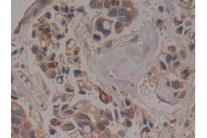 Detection of COIL in Human Breast cancer Tissue using Polyclonal Antibody to Coilin (COIL)