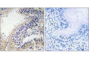 Immunohistochemistry analysis of paraffin-embedded human breast carcinoma tissue, using DHODH Antibody.