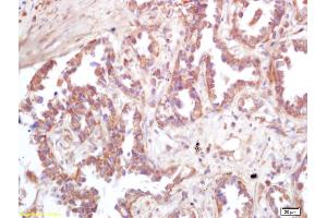 Formalin-fixed and paraffin embedded human lung carcinoma labeled with Rabbit Anti ATP6IP2 Polyclonal Antibody, Unconjugated (ABIN872738) at 1:200 followed by conjugation to the secondary antibody and DAB staining (ATP6AP2 anticorps  (AA 280-350))
