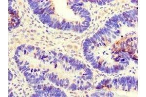 Immunohistochemistry of paraffin-embedded human ovarian cancer using ABIN7147403 at dilution of 1:100 (CEP290 anticorps  (AA 86-156))