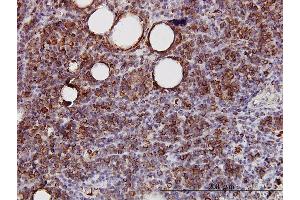 Immunoperoxidase of monoclonal antibody to SPRY2 on formalin-fixed paraffin-embedded human lymphoma.
