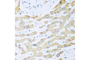 Immunohistochemistry of paraffin-embedded human liver cancer using FDXR antibody.