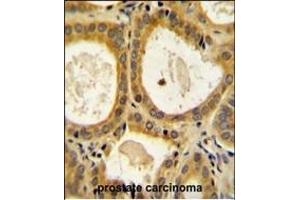 CTLA4 Antibody (N-term) (ABIN654422 and ABIN2844157) immunohistochemistry analysis in formalin fixed and paraffin embedded human prostate carcinoma followed by peroxidase conjugation of the secondary antibody and DAB staining. (CTLA4 anticorps  (AA 50-78))
